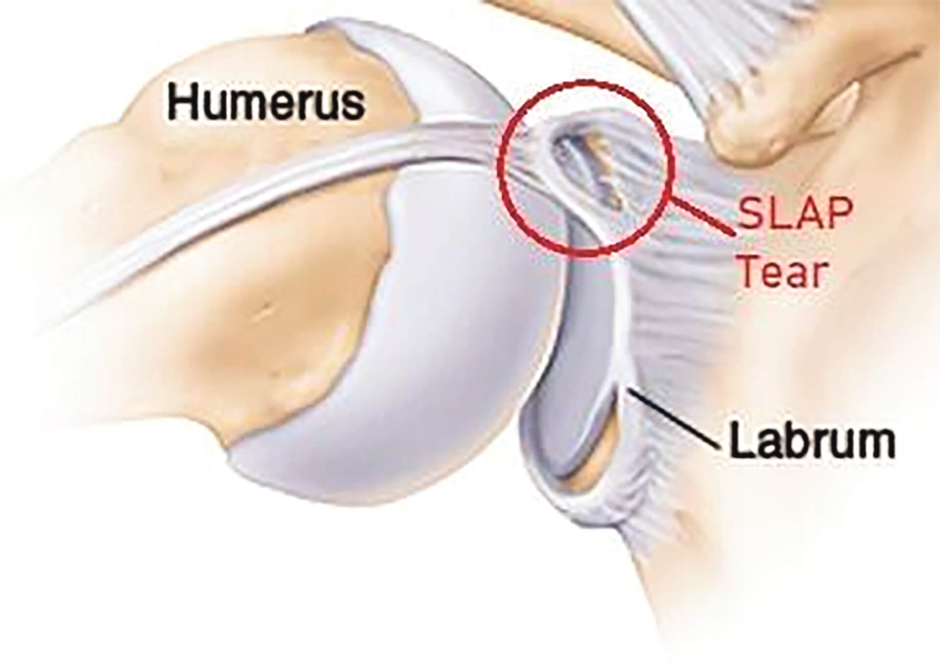 Labrum SLAP Tear (어깨 관절테두리 파열) - WowSeattle